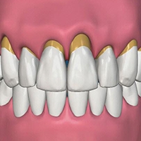 Implanturi dentare