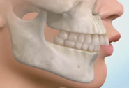 Protruzia dintilor frontali inferiori (Overjet negativ)