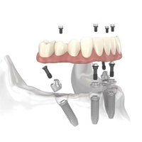 Puntea fixa pe implante dentare