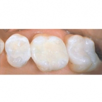 Implanturi dentare